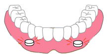 川村歯科クリニック　オーバーデンチャー　入れ歯